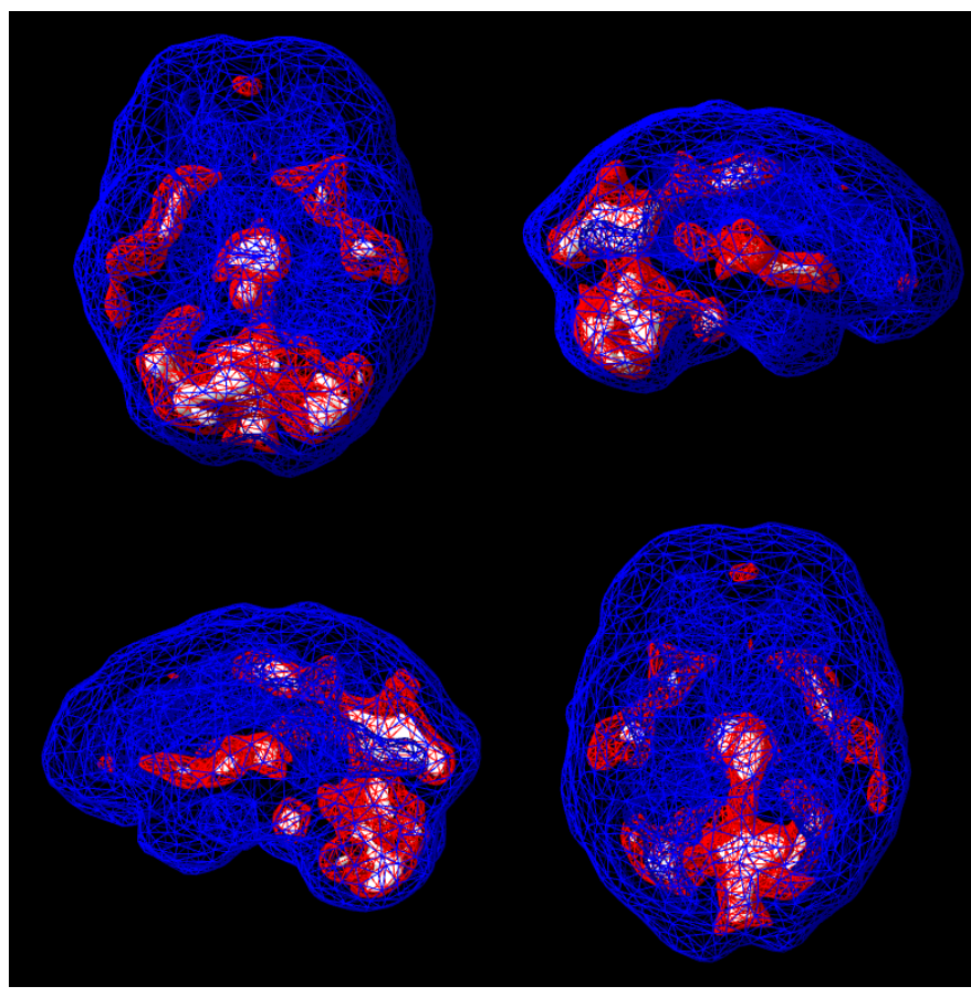 kevin's active blood-flow spect overlay, amen clinics, top 15% of blood flow shown as red hotspots on a blue wireframe brain surface, during concentration task, july 9, 2026 — clean render