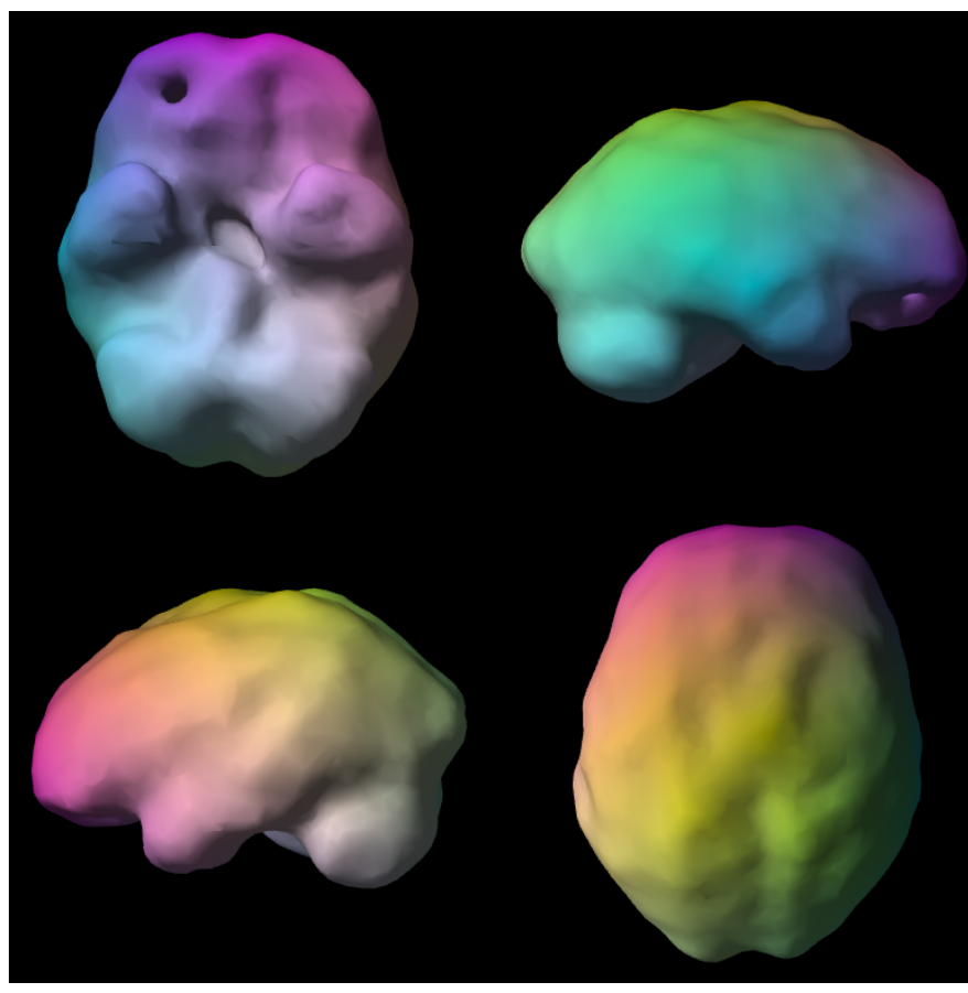 Baseline SPECT surface render — four-view brain montage, resting state